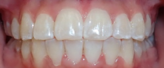 after orthodontic treatment