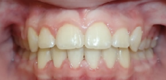 after orthodontic treatment