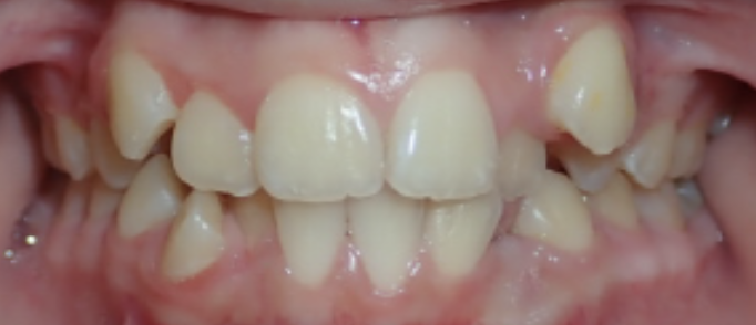 before orthodontic treatment