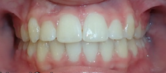 after orthodontic treatment