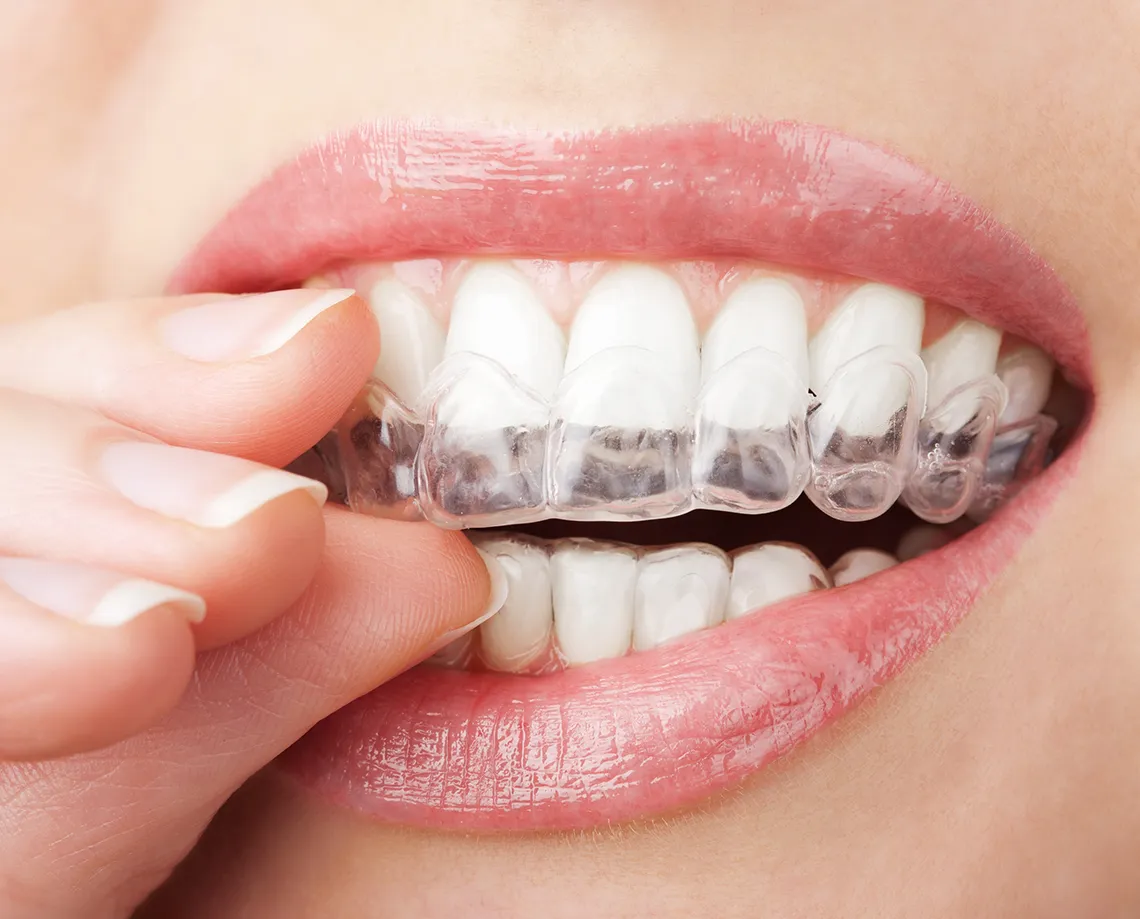 closeup of clear aligners or retainer
