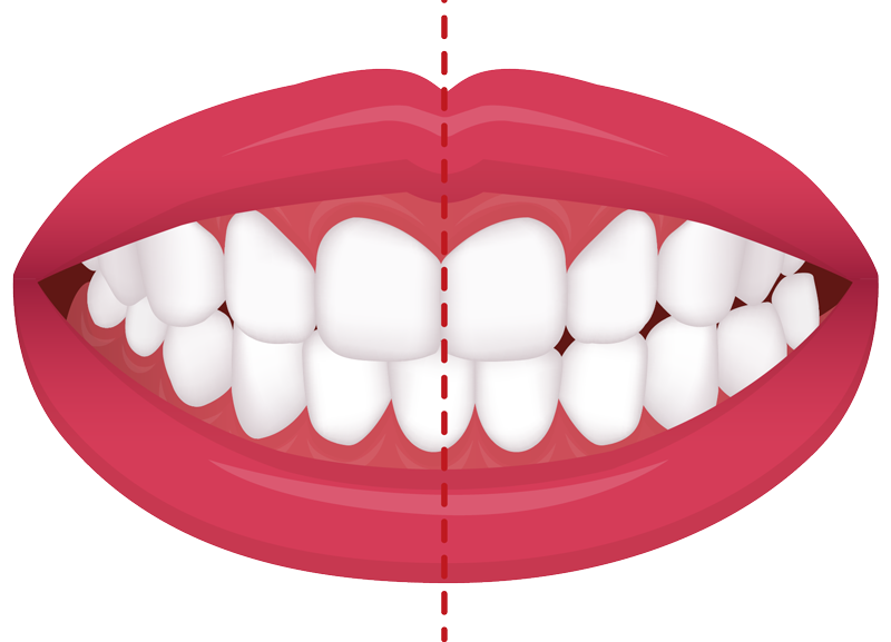 crossbite
