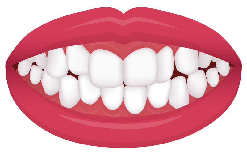 dental crowding