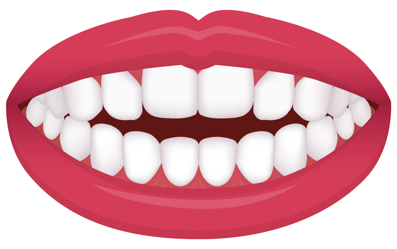 Open bite