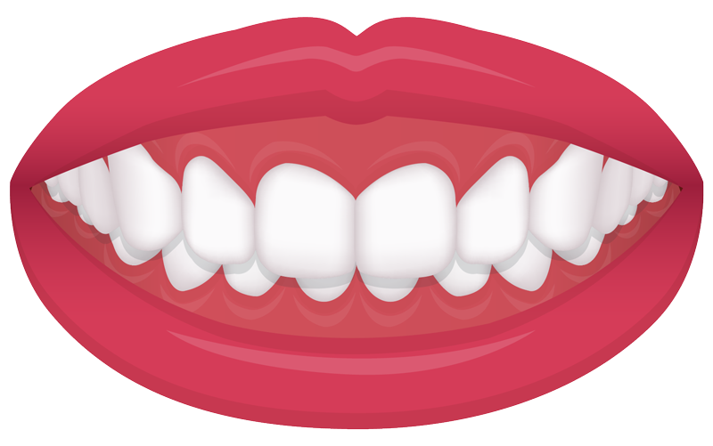 overbite or protrusion