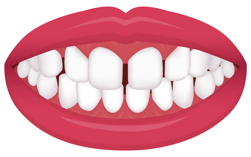 gaps between teeth