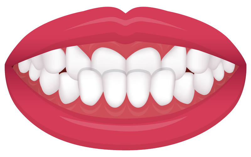 underbite